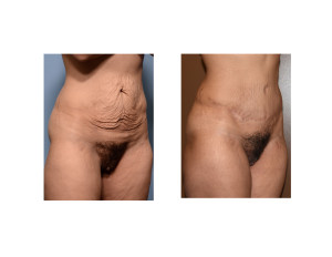 MR Tummy Tuck result oblique view