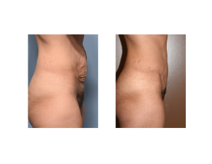 MR Tummy Tuck result side view