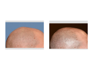 Sagittal Ridge Skull Reshaping result side view Dr Barry Eppley Indianapolis