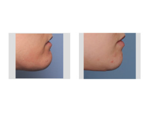 Submental Chin Reduction Reshaping result side view Dr Barry Eppley Indianapolis