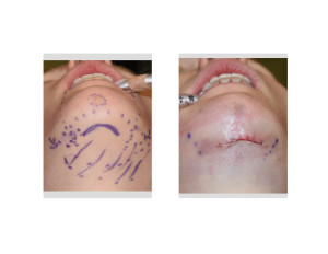 Submental Chin Reduction incision Dr Barry Eppley Indianapolis