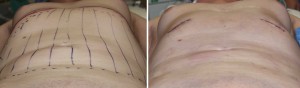 Anteriior Rib Removal Surgery intraop result below view Dr Barry Eppley Indianapolis