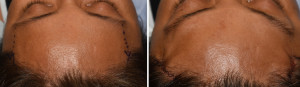 Bilateral Pretrichial Temporal Browllift result intraop Dr Barry Eppley Indianapolis