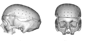 Current Total Skull Implant