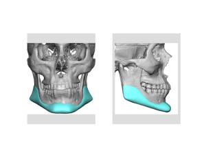 Custom Jawline Implant Replacement Dr Barry Eppley Indianapolis