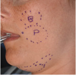 Facial Fat Reduction Zones Dr Barry Eppley Indianapolis