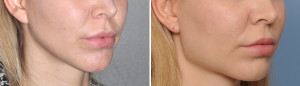 Female Square Jaw Angle Implants result oblique view Dr Barry Eppley Indianapolis