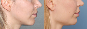 Female Square Jaw Angle Implants result side view Dr Barry Eppley Indianapolis