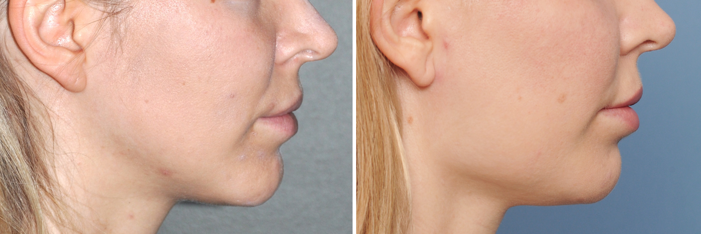Jaw angle implants historically were one style that only widened the jaw an...