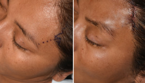 Left Pretrichial Temporal Browlift result intraop Dr Barry Eppley Indianapolis