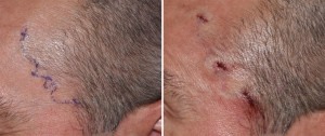Left Temporal Artery Ligation Dr Barry Eppley Indianapolis