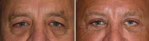 Male Transpalpebfal Browlift result front view Dr Barry Eppley Indianapolis