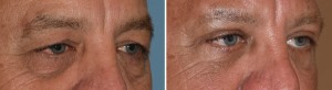 Male Transpalpebral Browlift results oblique view Dr Barry Eppley Indianapolis