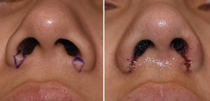 Nostril Narrowing intraop before and after result Dr Barry Eppley Indianapolis