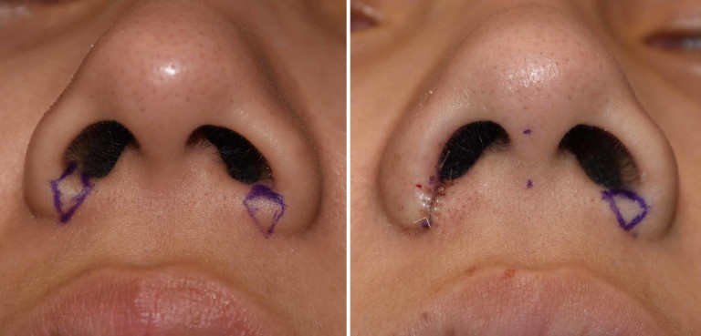 Technique Of Alar Wedge Nostril Narrowing - Explore Plastic Surgery