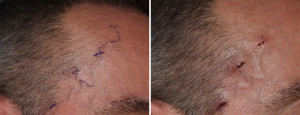 Right Temporal Artery Ligation Dr Barry Eppley Indianapolis