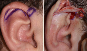 Scaphal Vertical Ear Reduction intraop Dr Barry Eppley Indianapolis