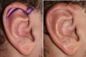 Small Vertical Ear Reduction result Dr Barry Eppley Indianapolis