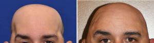 Total Skull Implant reconstruction result front view Dr Barry Eppley Indianapolis