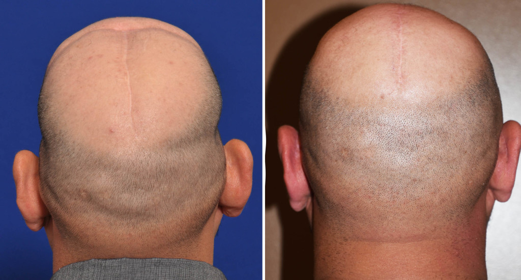 Total Skull Implant Reconstruction Results Back View Dr Barry Eppley Indianapolis Explore