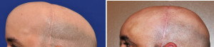 Total Skull Implant reconstruction results side view Dr Barry Eppley Indianapolis