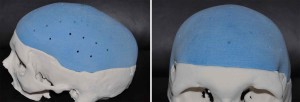 Total Skull Replacement Implant design Dr Barry Eppley Indianapolis