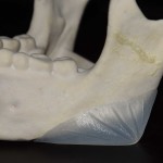 vertical lengthenign jaw angle implant style dr barry eppley indianapolis