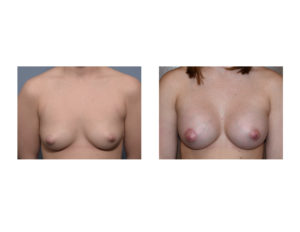 Breast augmentation with right nipple liftresults front view Dr Barry Eppley Indianapolis