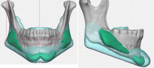 Custom Jawline Implant desigjn over existing jaw implants Dr Barry Eppley Indianapolis