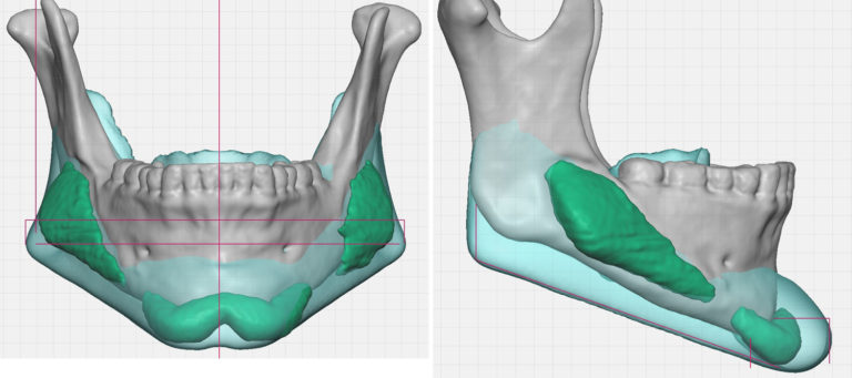 Plastic Surgery Case Study Custom Jawline Implant Replacement For