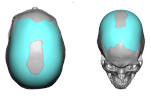 Custom Parasagittal Skull Implant design Dr Barry Eppley Indianapolis
