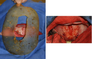 Custom Parsagittal Skull Implant intraop Dr Barry Eppley Indianapolis