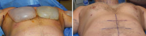 Extra Large Custom Pectoral Implant immediate intraop result below view Dr Barry Eppley Indianapolis