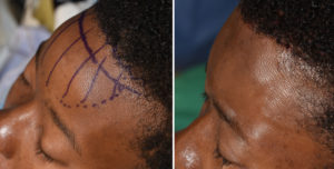 Forehead Bony Reduction with Hairline Advancement intraop result left oblique view Dr Barry Eppley Indianapolis