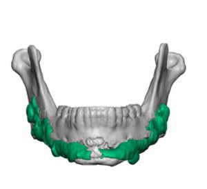 Hydroxyapatite Jawline-Augmentation-Dr-Barry-Eppley-Indianapolis