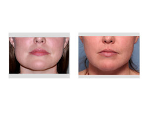 Jaw Asymmetry Surgery result front view Dr Barry Eppley Indianapolis