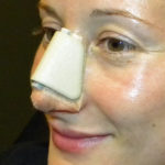 Rhinoplasty (Taping and Nasal Splint) Dr Barry Eppley Indianapolis