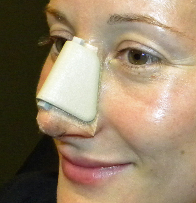 Rhinoplasty (Taping and Nasal Splint) Dr Barry Eppley Indianapolis