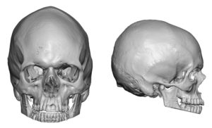 Sagittal Crest Skull Deformity Dr Barry Eppley Indianapolis