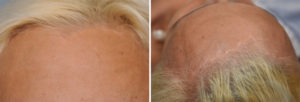 Total Forehead Reduction hairlinke scar result Dr Barry Eppley Indianapolis