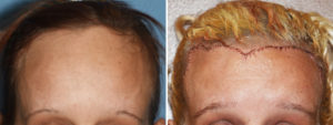 Total Forehead Reduction result front view Dr Barry Eppley Indianapolis