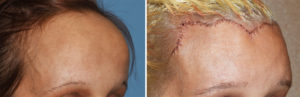 Total Forehead Reduction result oblique view Dr Barry Eppley Indianapolis