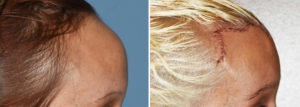 Total Forehead Reduction result side view Dr Barry Eppley Indianapolis