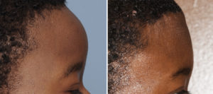 Total Forehead Reduction result side view Dr Barry Eppley Indianapolis