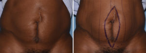 Vertical Tummy Tuck markings Dr Barry Eppley Indianapolis