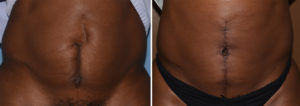 Vertical Tummy Tuck result Dr Barry Eppley Indianapolis