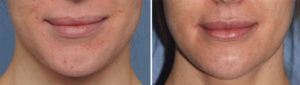 Chin Reduction Reshaping Osteotomies result front view Dr Barry Eppley Indianapolis