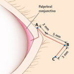 Lateral Canthal Lengthening