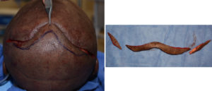 Redundant Scalp removal after occipital skull reduction dr barry eppley indianapolis