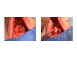 T-Shaped Chin Reduction intraop 2 Dr Barry Eppley Indianapolis